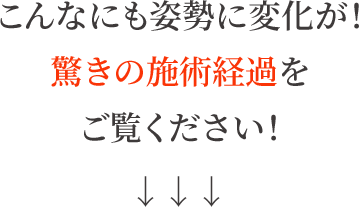 こんなにも姿勢に変化が!驚きの施術経過をご覧ください!
